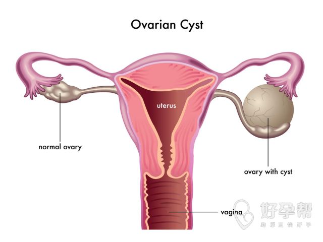 输卵管堵塞的症状原因是什么？为什么会出现输卵管堵塞？