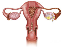 无痛输卵管造影有什么副作用？造影可以治疗输卵管堵塞么？