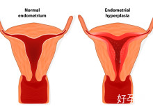 子宫内膜异位症的后果是什么？子宫内膜异位症会有哪些症状？