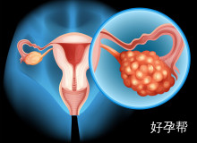子宫内膜增厚多久癌变？子宫内膜增厚会癌变吗？