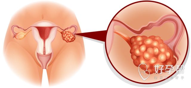 子宫内膜增厚的症状是什么？子宫内膜增厚有哪些表现？