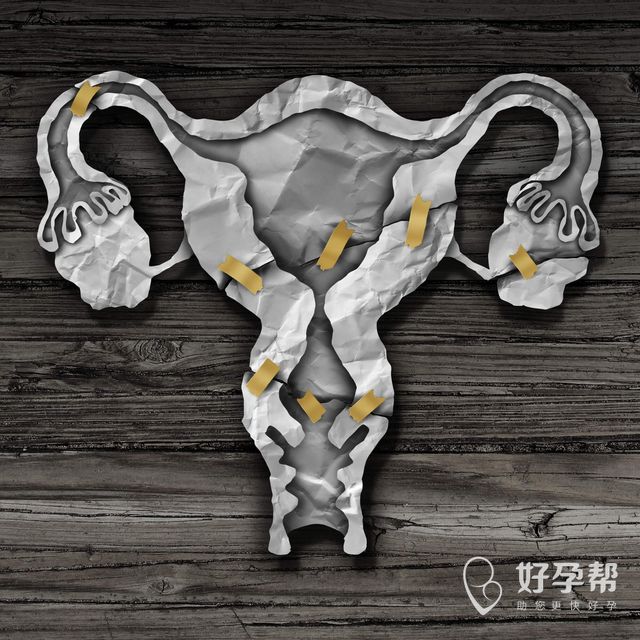 腺肌症的最佳治疗方法是什么？如何治疗子宫腺肌症？