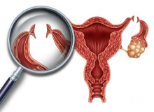子宫内膜息肉的症状是什么？子宫内膜息肉有哪些表现？