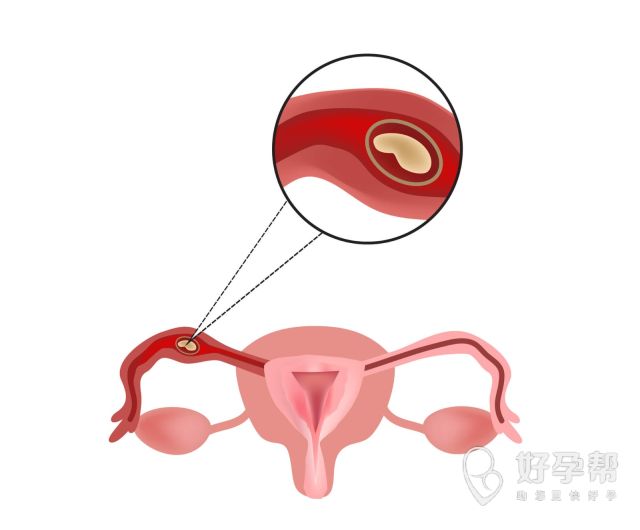 子宫内膜息肉会癌变吗？子宫肌肉引发癌变会有什么原因？