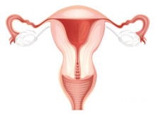 多发性子宫肌瘤一定要切除子宫吗？如何有效预防多发性子宫肌瘤？