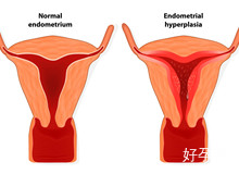子宫增大内膜增厚什么原因是什么？子宫内膜为什么会增大？