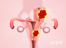 宫腔粘连严重的症状是什么？宫腔粘连容易引发什么情况？