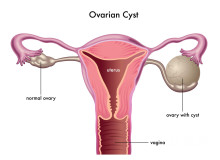 子宫内膜异位怎么检查？子宫内膜异位症有哪些检查方法？