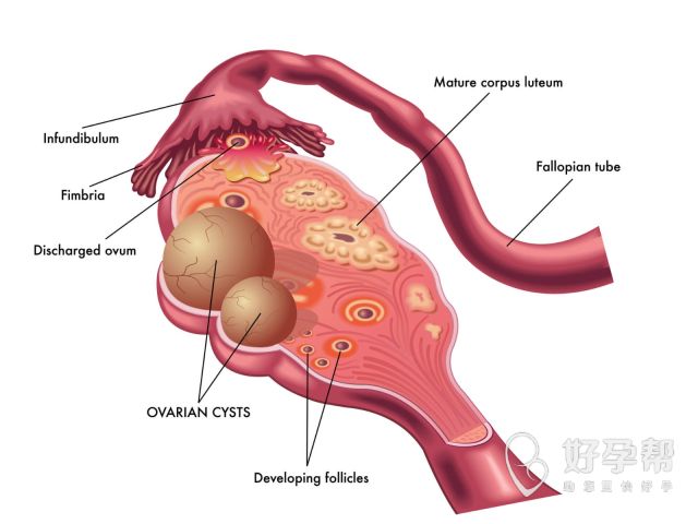 子宫肌瘤可以吃鱼胶吗？子宫肌瘤要改掉哪些饮食习惯？