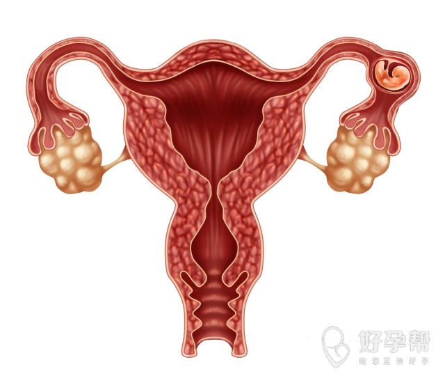子宫肌瘤开腹手术过程是什么？子宫肌瘤开腹手术如何保养？