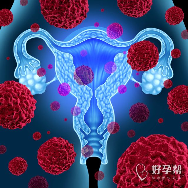 浆膜下子宫肌瘤严重吗？浆膜下子宫肌瘤有哪些症状？