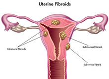 子宫肌瘤吃什么药最好？子宫肌瘤有哪些合适的药物？