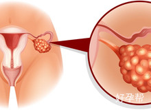 卵巢囊肿巧克力囊肿能制排卵吗？卵巢囊肿会带来哪些影响？