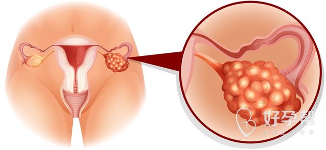 卵巢囊肿巧克力囊肿能制排卵吗？卵巢囊肿会带来哪些影响？