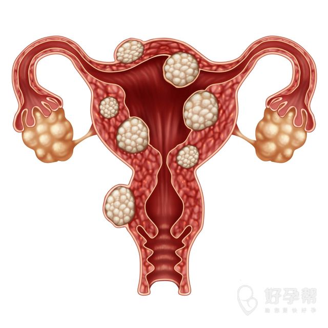 双侧卵巢巧克力囊肿有哪些症状？双侧卵巢巧克力囊肿有什么表现？