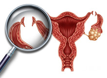 人流后出现卵巢囊肿怎么回事？怎样治疗才好？
