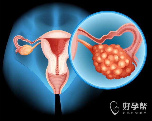 卵巢癌的早期症状验血查什么？卵巢癌有什么早期症状？