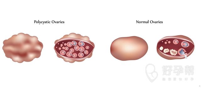 高泌乳素症能治好吗？高泌乳素症应该如何治疗？