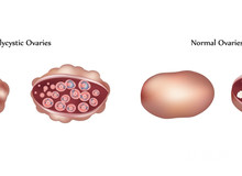 高泌乳素症能治好吗？高泌乳素症应该如何治疗？