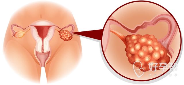 做完宫腔镜不出血好吗？做完宫腔镜应该出血吗？