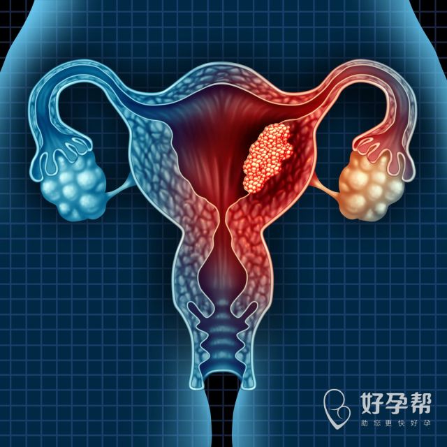 多囊卵巢怀孕要保胎吗？怀孕需要注意哪些事？
