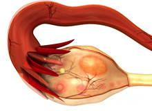 卵巢囊肿对卵子质量有影响吗？会影响排卵吗？