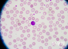 舒兰管积水做试管怎么样?输卵管积水如何做试管?