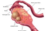 多囊卵巢患者福音：泰国试管婴儿个性化治疗方案