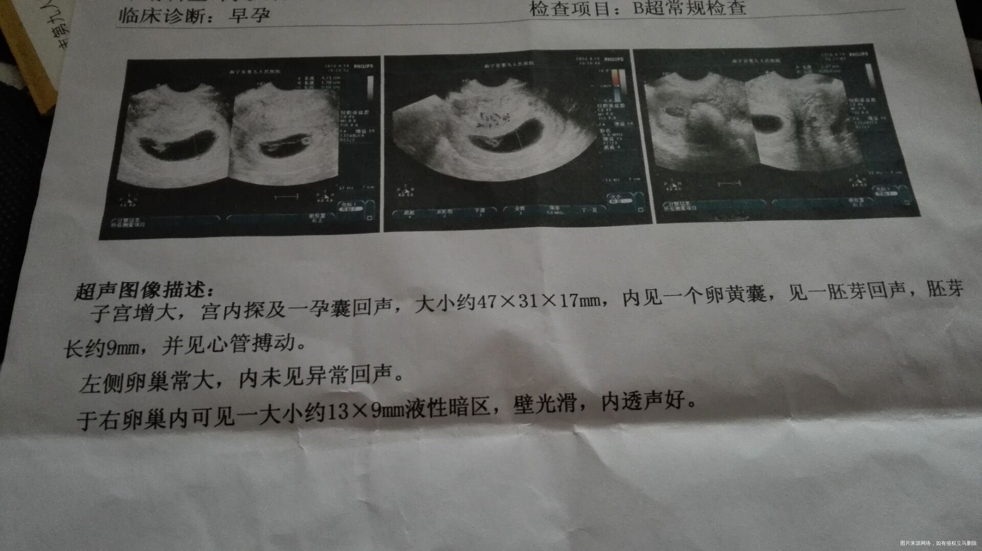 【备孕经历】备孕半年成功当上妈妈