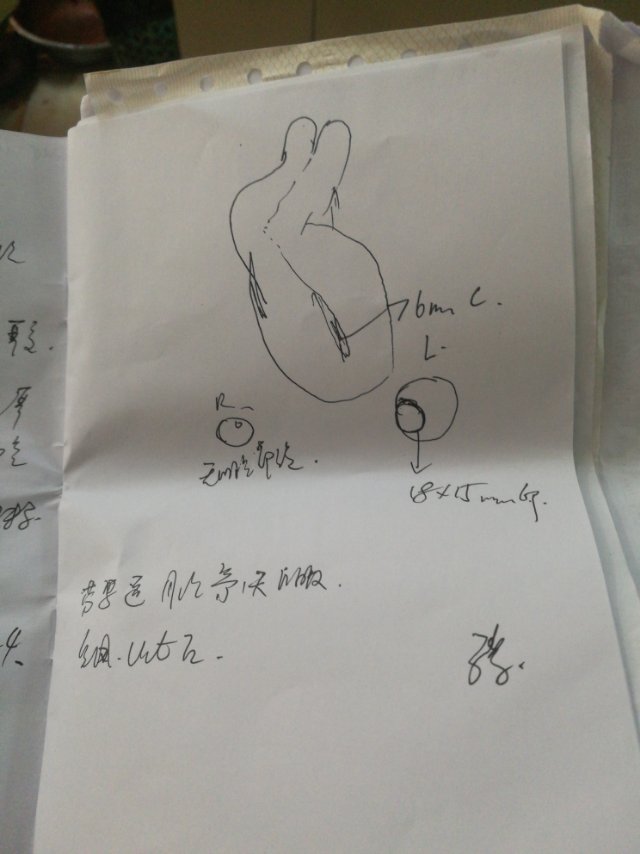 我例假周期今天已经38天了期间有两次卵泡发育