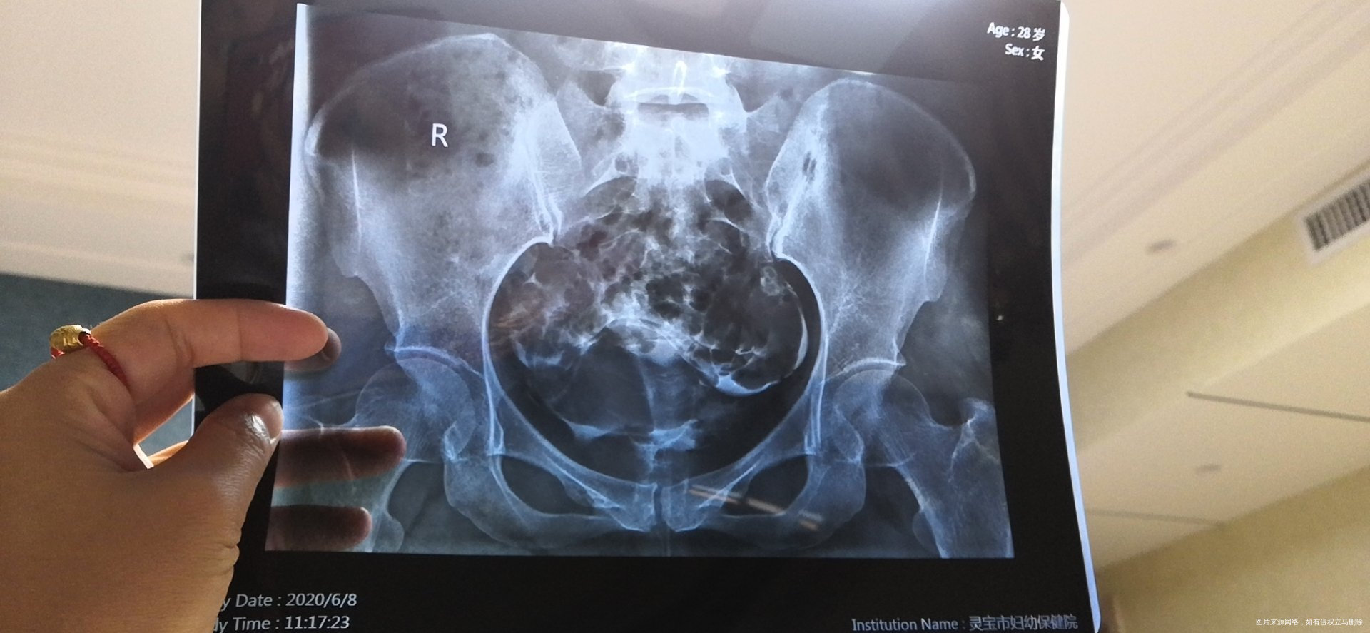 可以帮忙看一下输卵管片子吗4个图的是第一次造