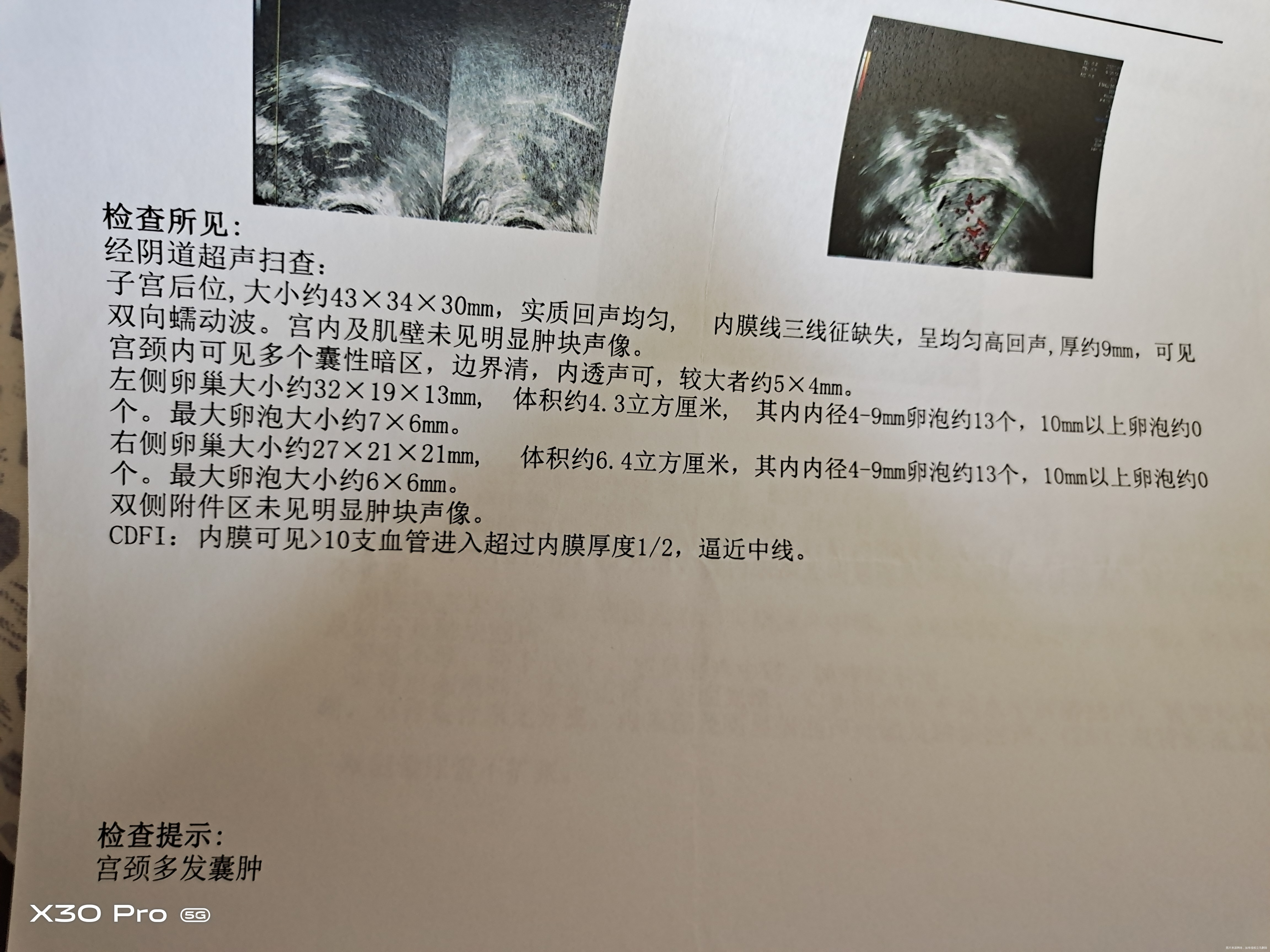 这个月12号做了造影结果双侧输卵管炎性粘连伴