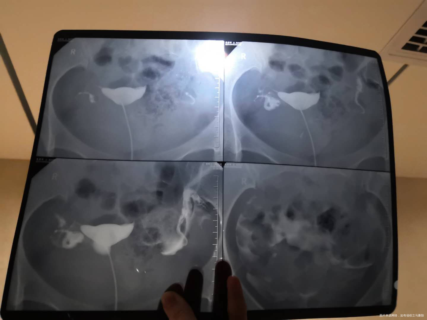 可以帮忙看一下输卵管片子吗4个图的是第一次造