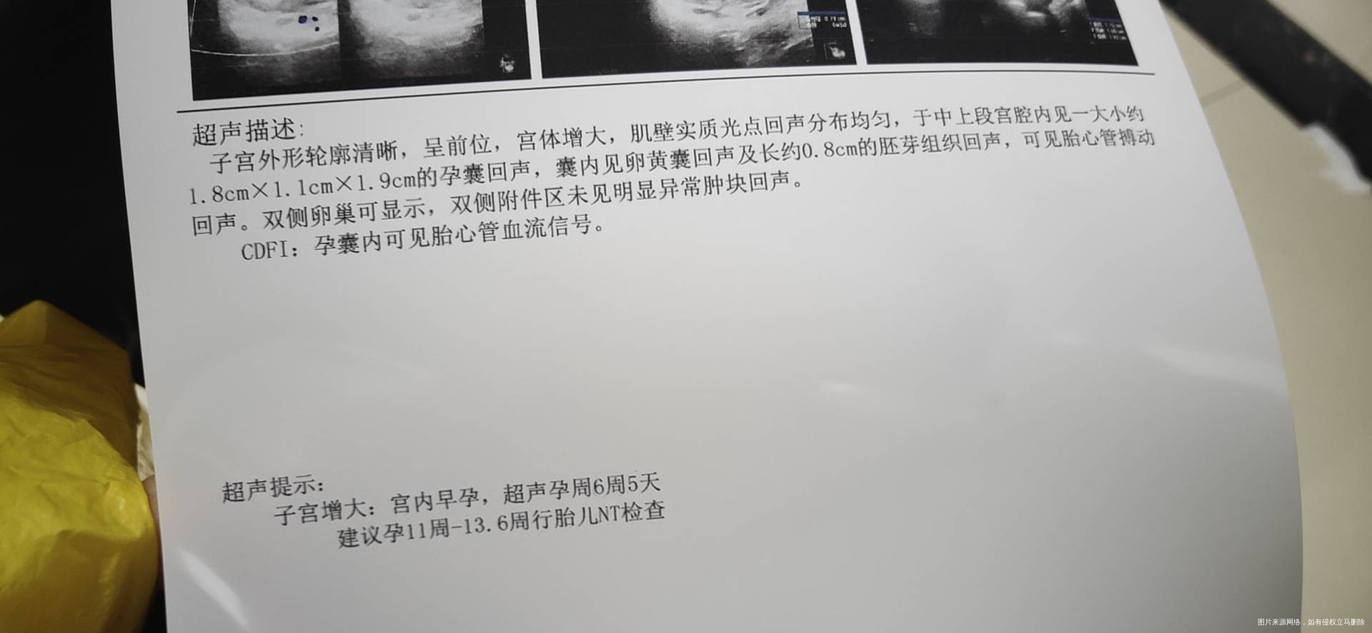 多囊没有优势卵泡促排怀孕一促生化了这是二促怀