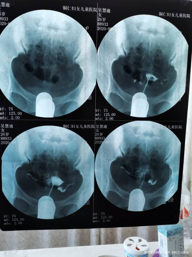 左侧卵巢先天性发育不良不用管它我想问下我的右