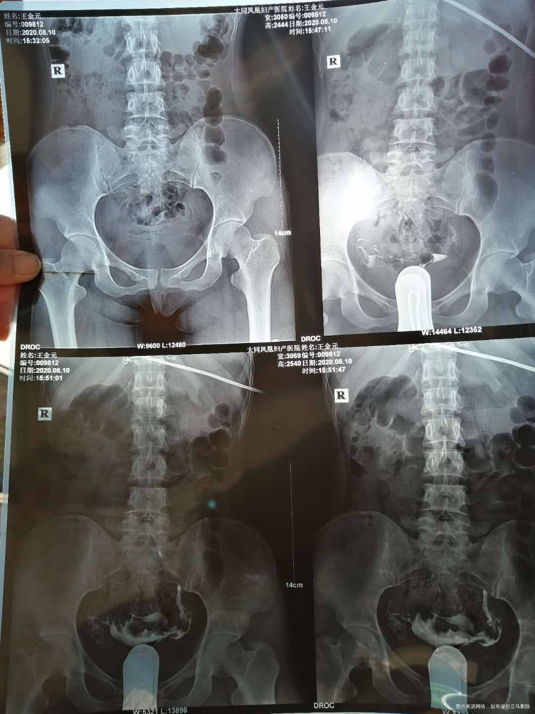 照影的结果是一边通而不畅一边显影并上举请问医