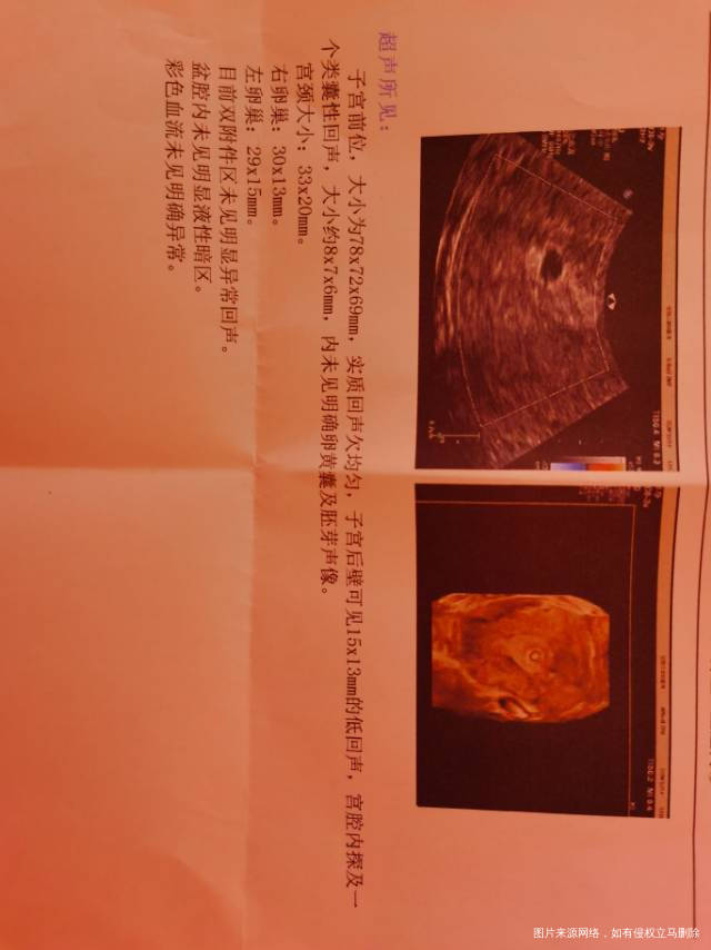 移植冻胚28天孕囊8x7x6无胎心胎芽无卵黄