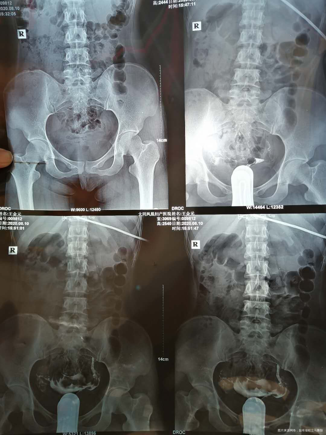 照影的结果是一边通而不畅一边显影并上举请问医