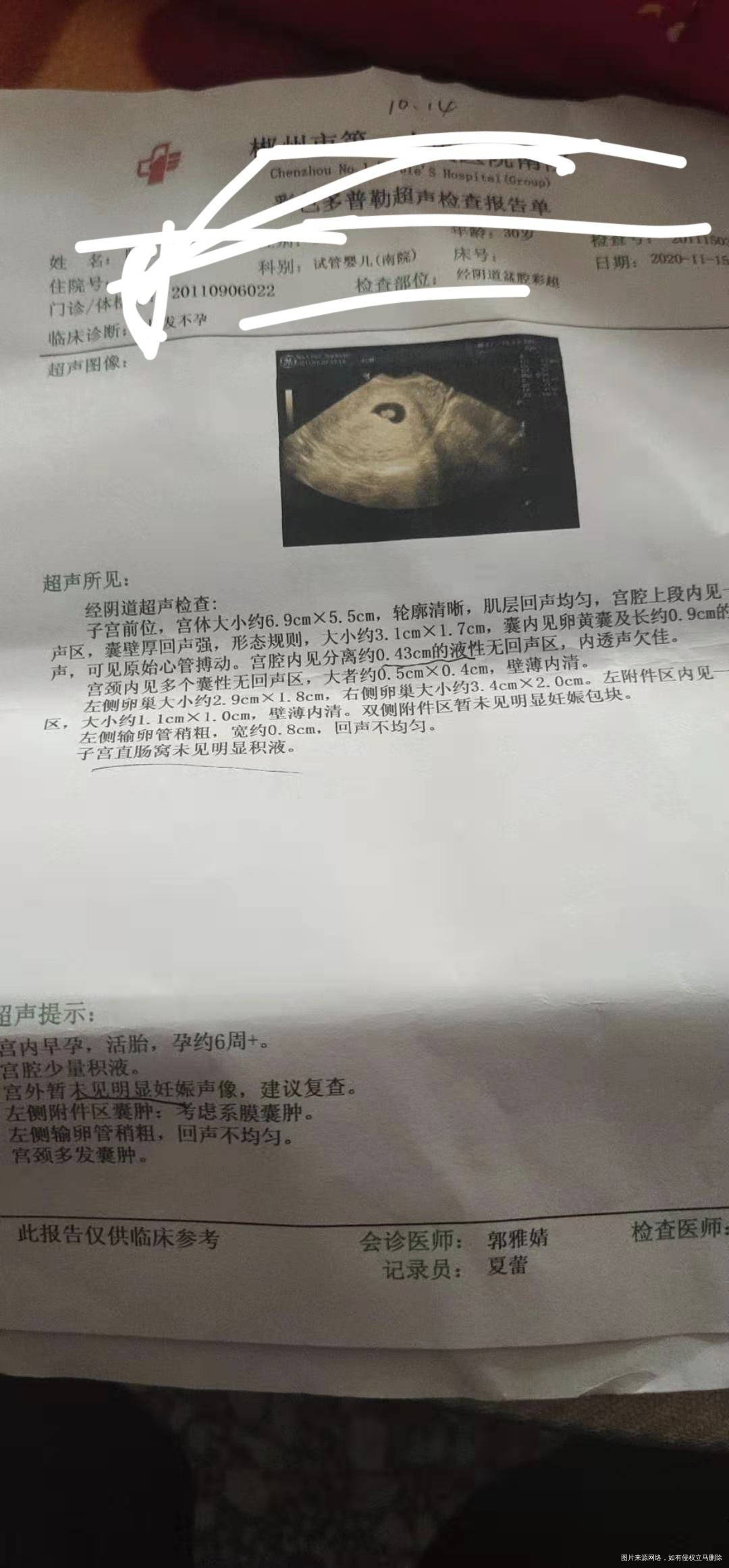 移植一个月流血有点多开始一天流一点去医院看了