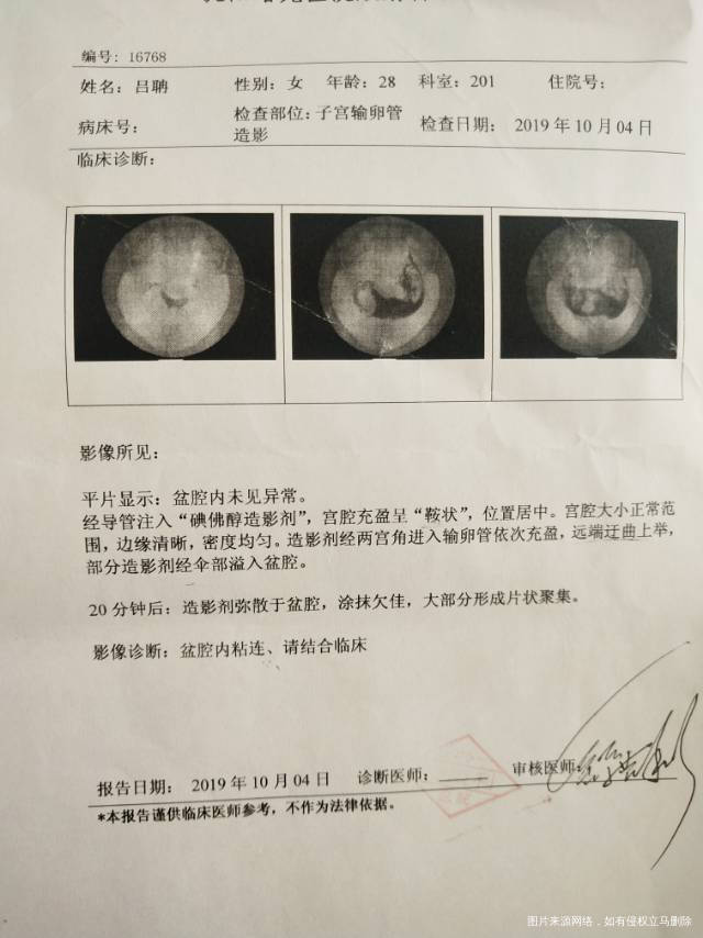 我是多囊没做输卵之前促排过四次怀过一次生化了