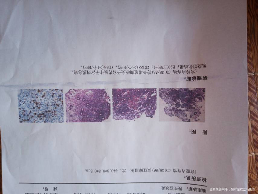 输卵管堵塞做的试管婴儿有子宫息肉做了宫腔镜检