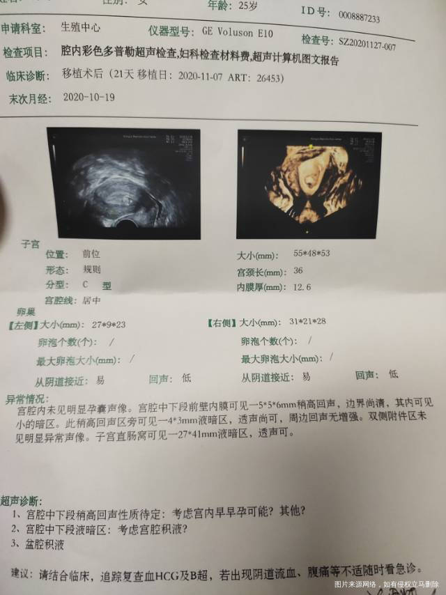 试管移植21天12天hcg22214天226