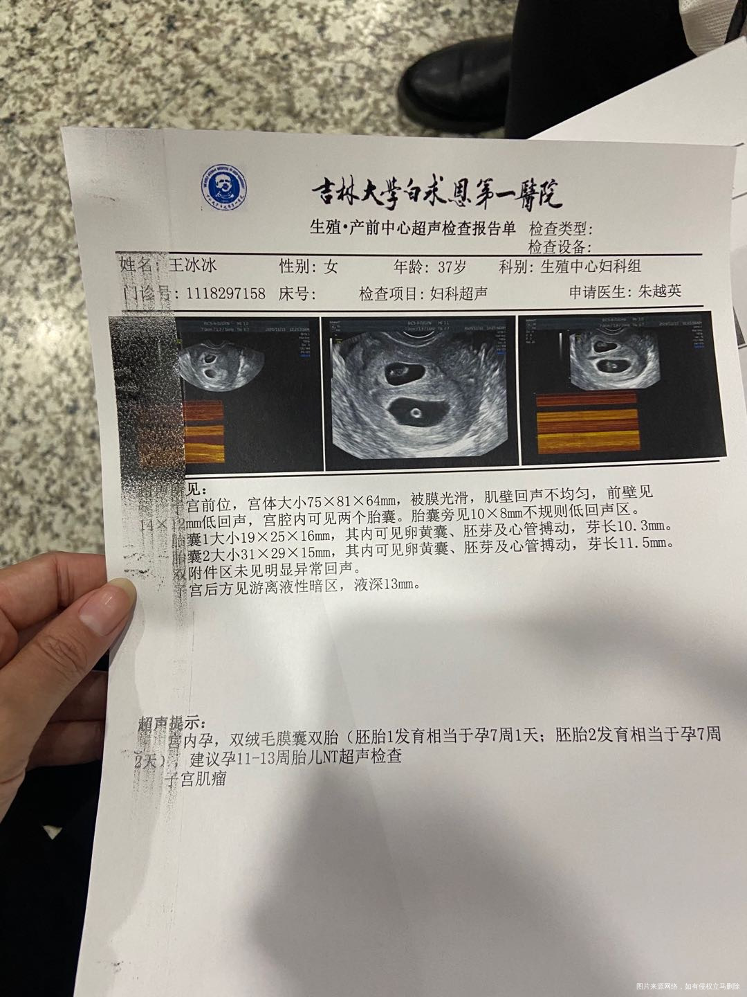 今天试管移植第34天看见胎心胎芽了之前没啥感