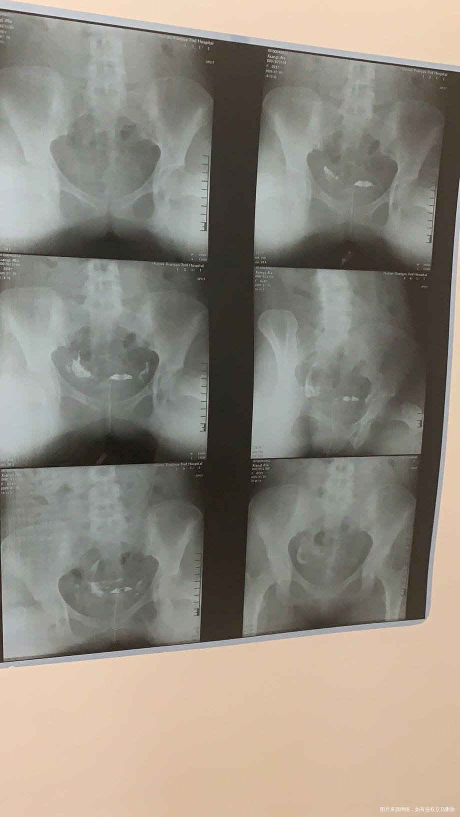 是多囊还是雌激素低同房干涩月经29天周期三天