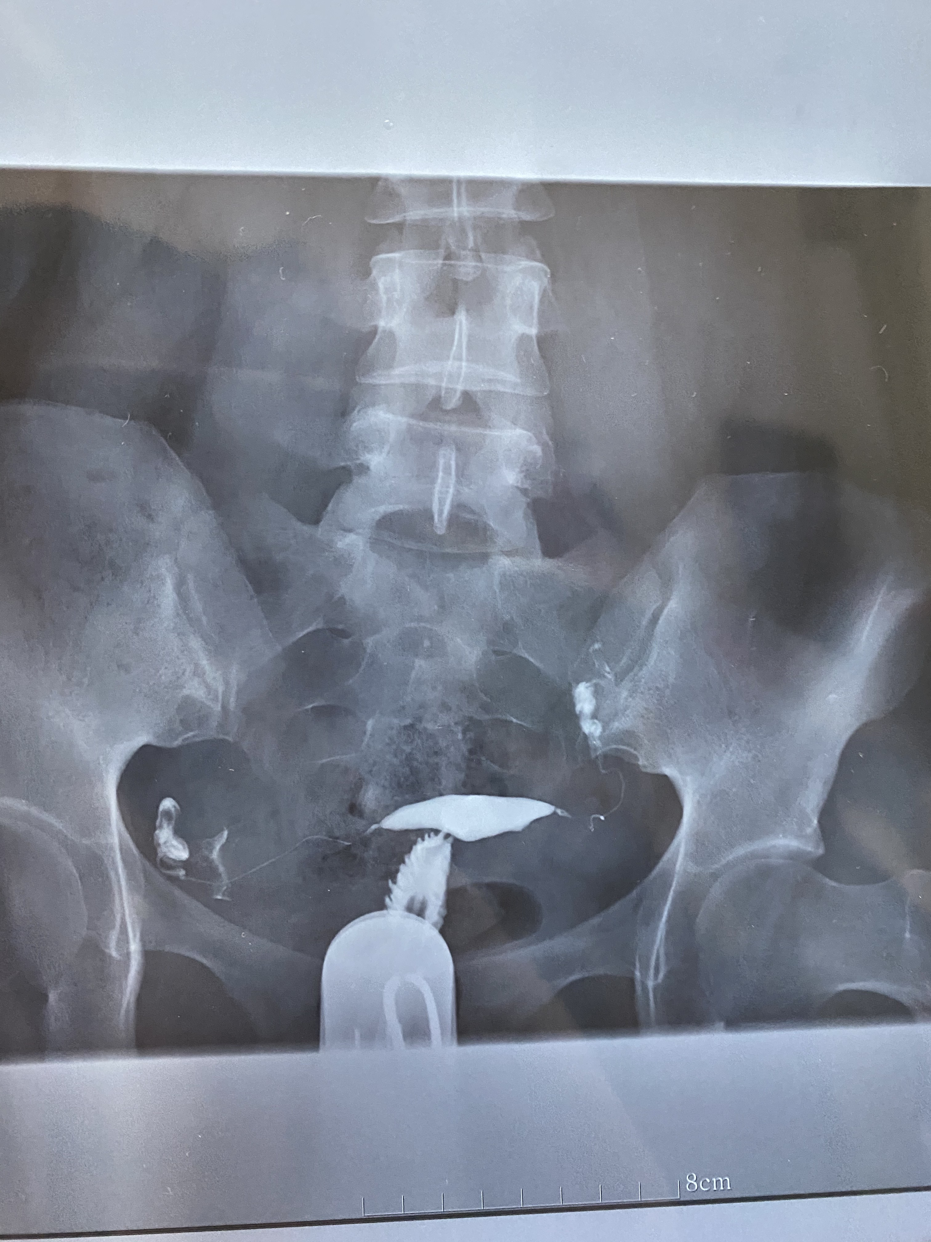 医生您好帮我看看输卵管报告报告上虽然没有异常