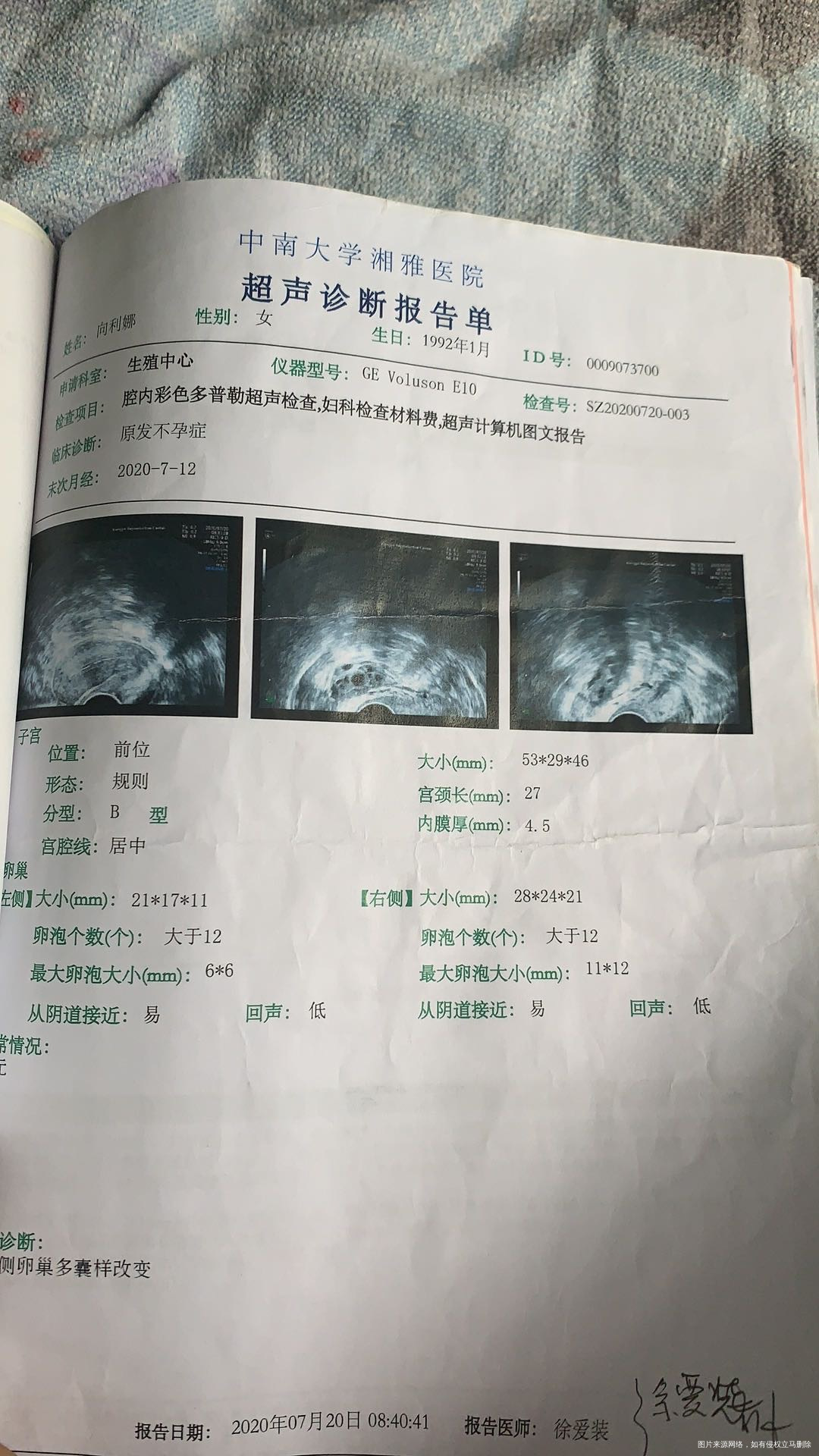 是多囊还是雌激素低同房干涩月经29天周期三天