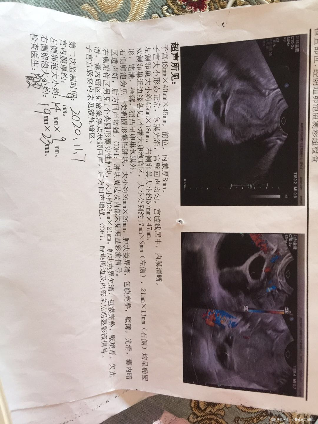 117检测卵泡19×23118监测变成38的