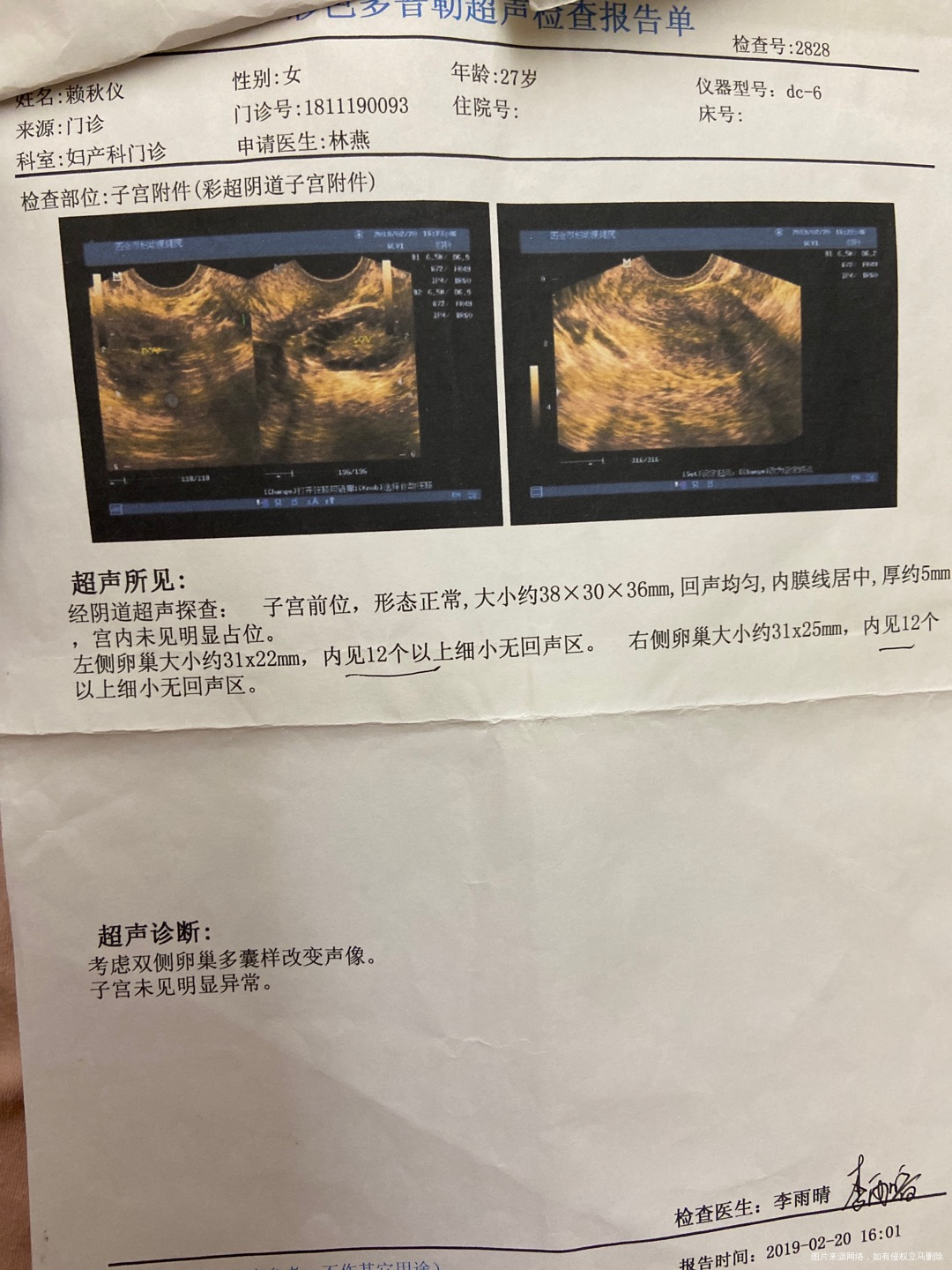 多囊需要怎么治疗想要宝宝药物促排2次还不行月