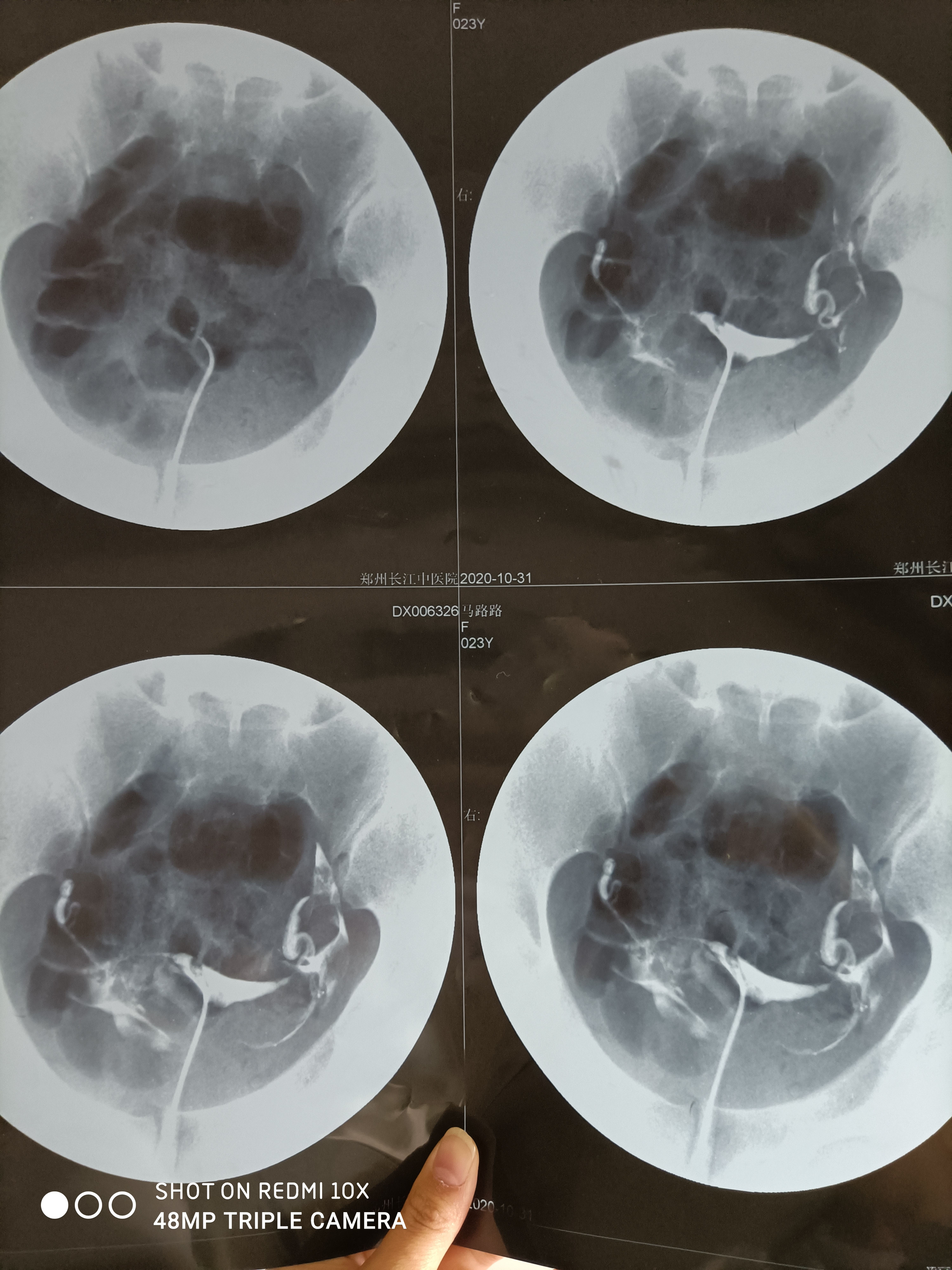 医生您好上个星期去一个小医院检查了对结果不太