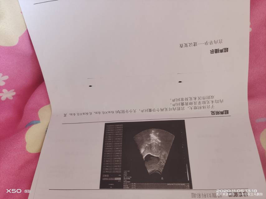 促排取卵后3天移植鲜胚2枚14天验血hcg5